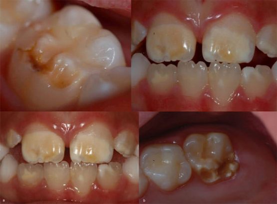 defectos del esmalte dental